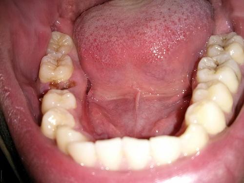 成人蛀牙可怕视频讲解,视频深度解析