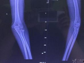 成人骨折宣传视频